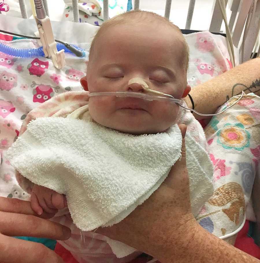 Close up of baby with down syndrome asleep with oxygen tube up her nose