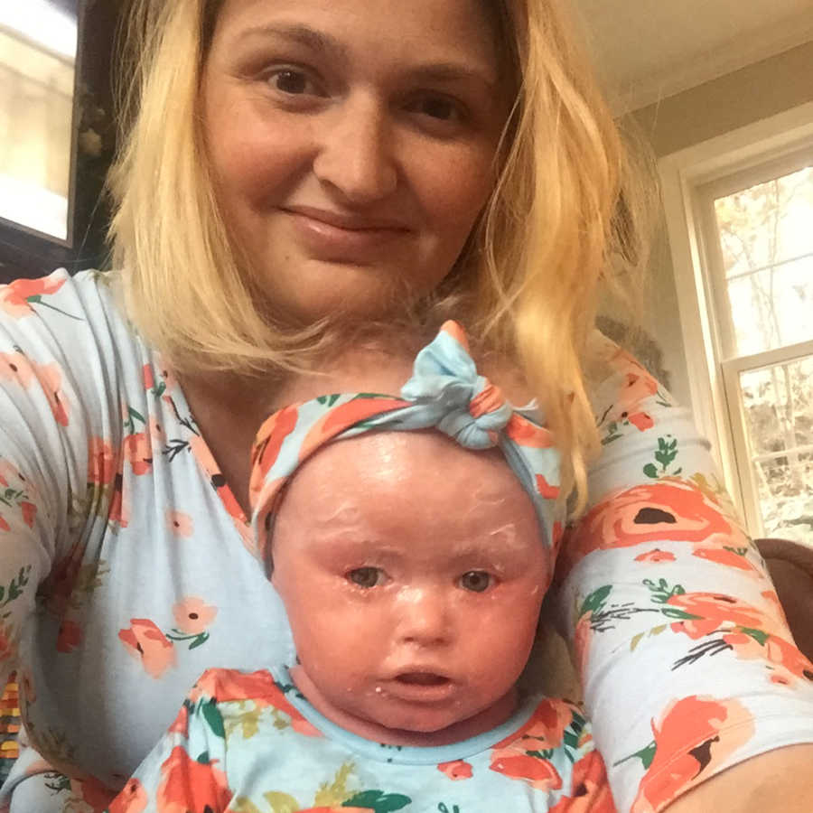 Mother smiles in selfie with daughter who has Harlequin Ichthyosis who is wearing matching onesie to her shirt