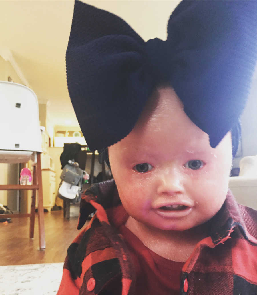 Close up of baby girl with Harlequin Ichthyosis wearing big black bow on her head