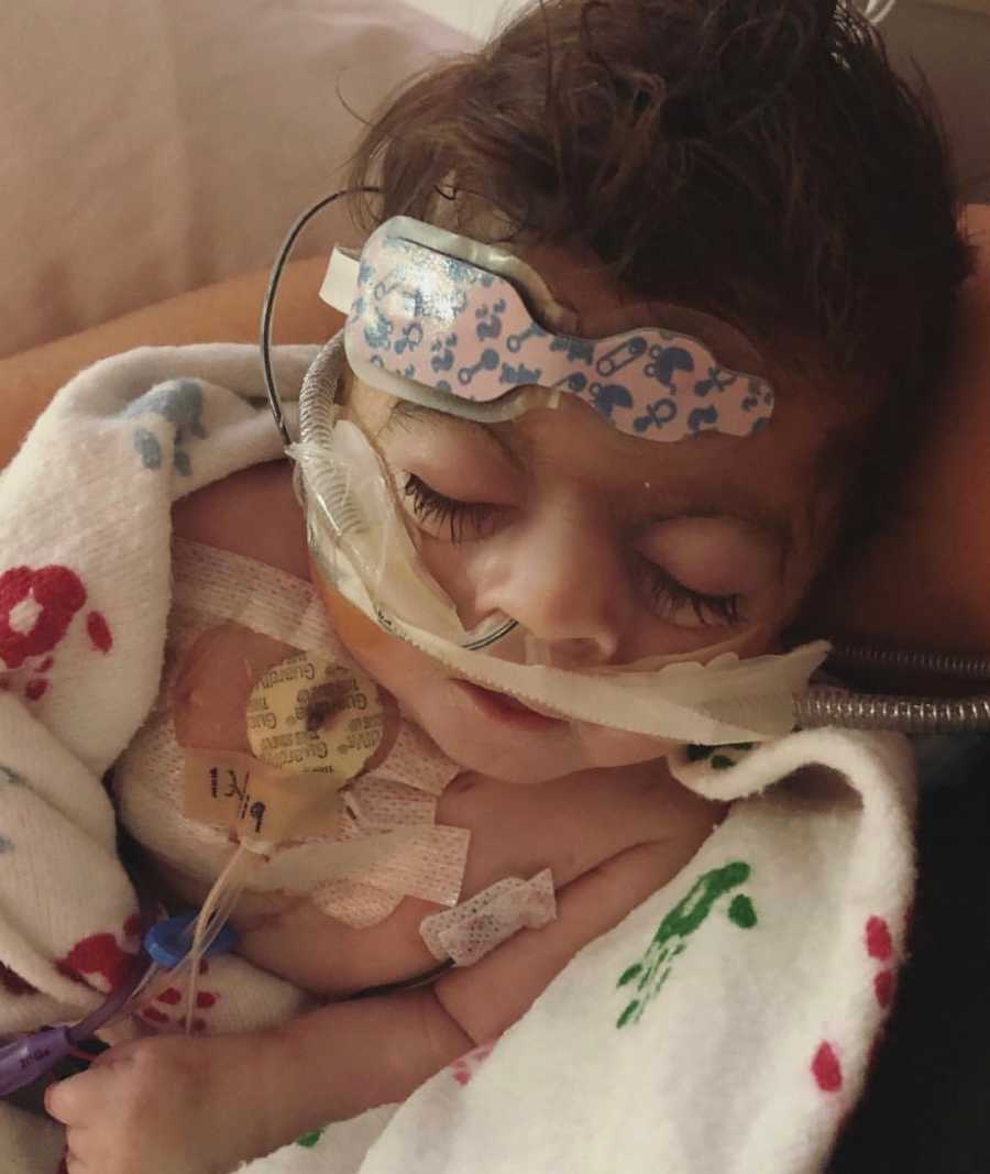 Baby with Cornelia de Lange syndrome asleep with wires attached all over his body and wire up his nose