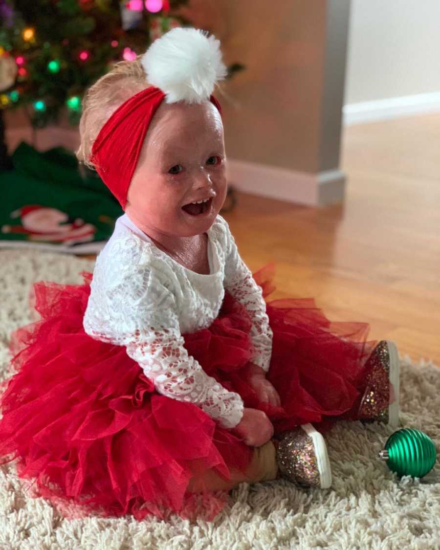 Baby with Harlequin Ichthyosis sits on carpet in red tutu beside green ornament 