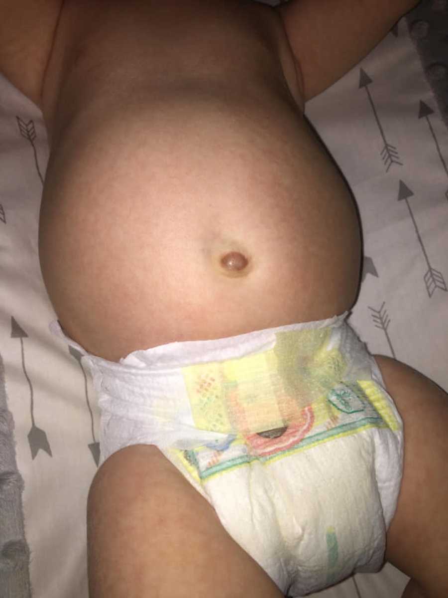 Close up of baby with neuroblastoma stomach