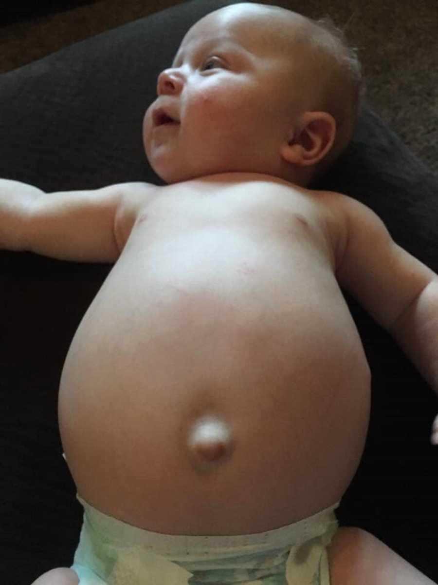 Shirtless baby lays on his back exposing large stomach that is full of tumors