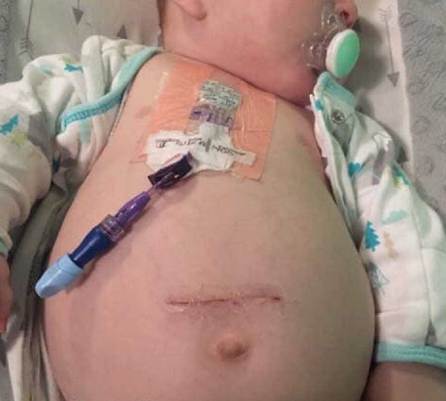 Baby with neuroblastoma lays on back with onesie unbuttoned to show scar and IV in his chest