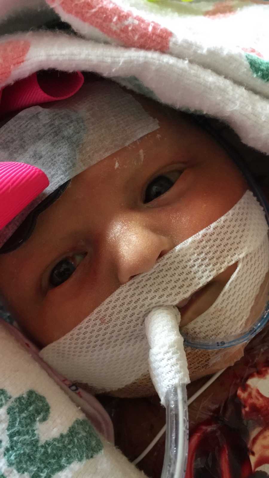Newborn with pentalogy of cantrell is wrapped in blanket with tube taped to her mouth