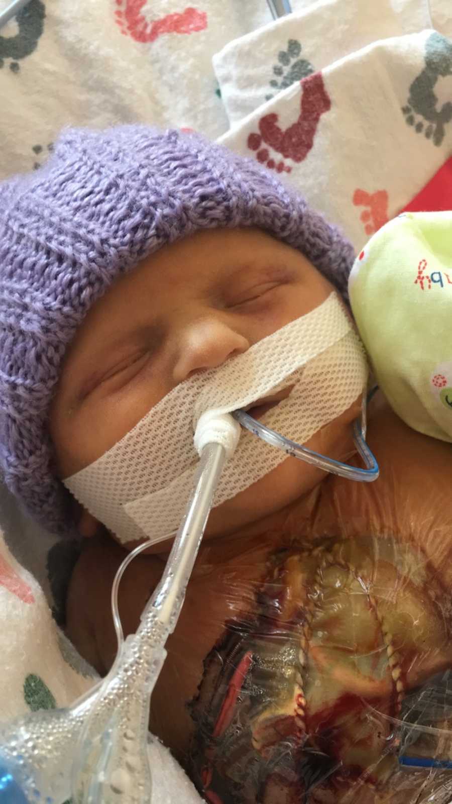 Newborn lays asleep in NICU wearing purple hat and tube taped to her mouth with wound on her chest