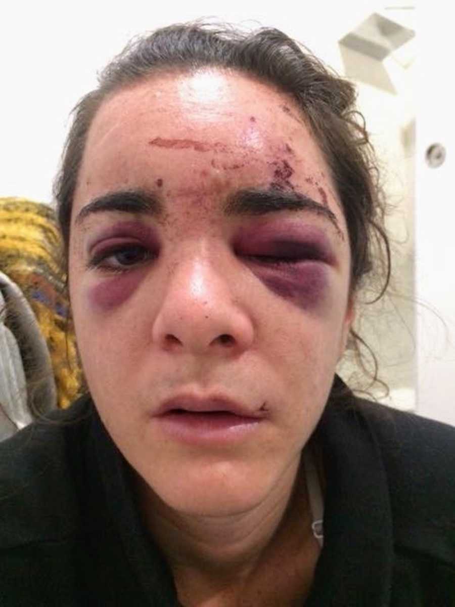 Close up of woman's face who was beaten by stranger in international country