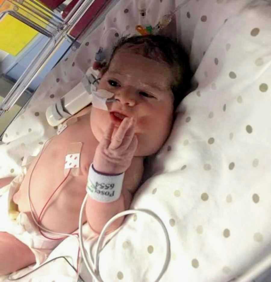 Baby with lymphatic malformation lays in NICU on her back