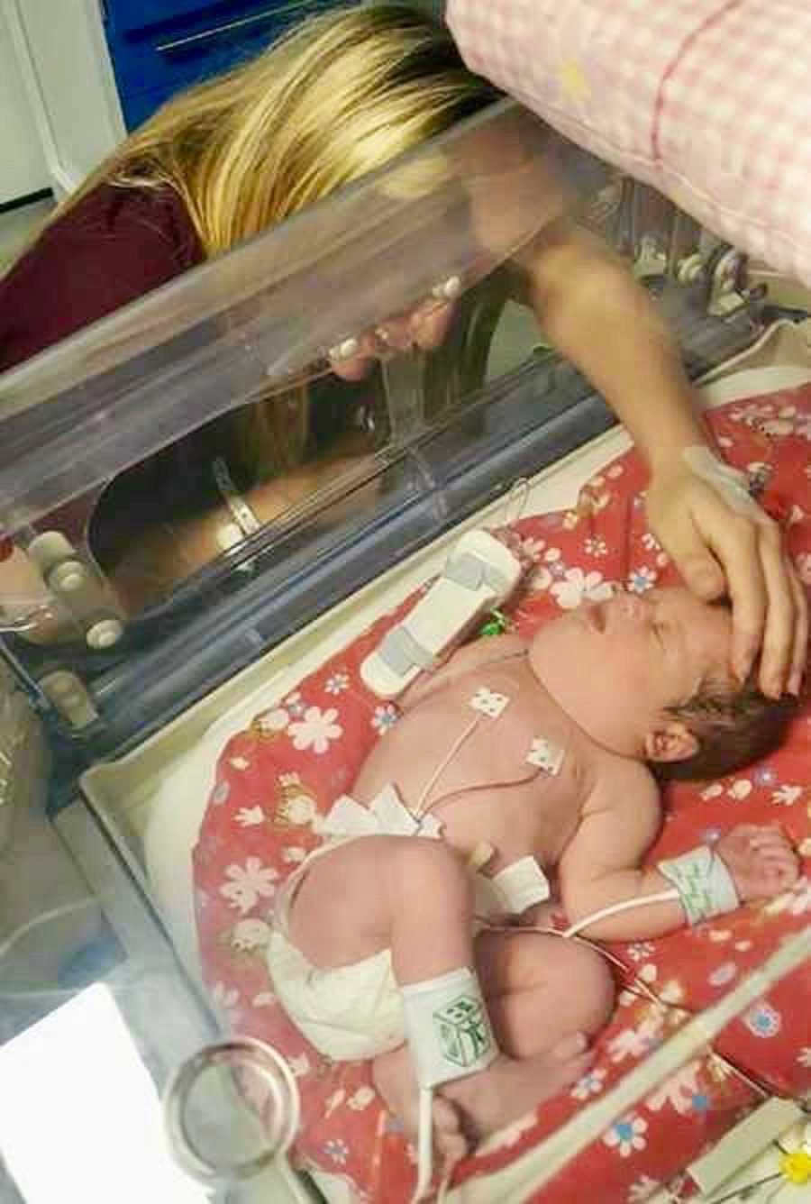 Baby with cystic hygroma lays in Children's Hospital hooked up to monitors as her mother rests hand on her head