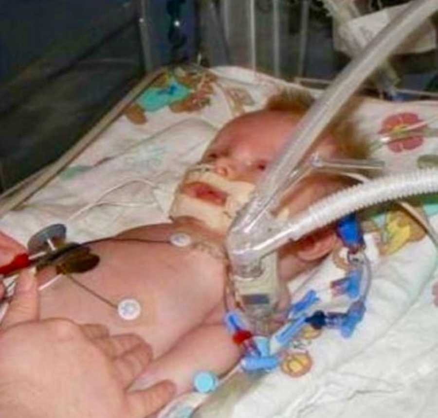 Baby in PICU with shaken baby syndrome