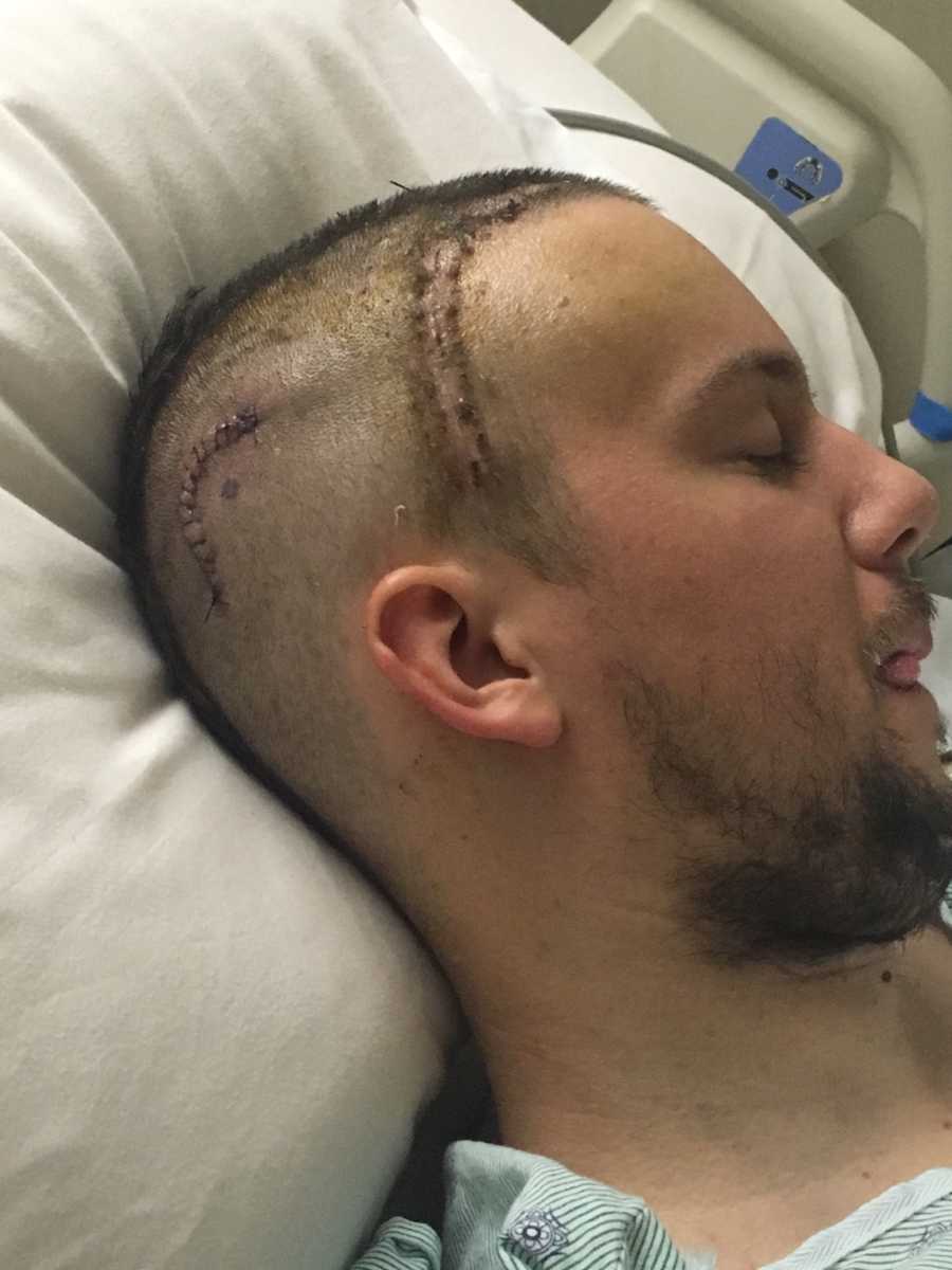 Man laying in ICU with stitches on his head from car crash