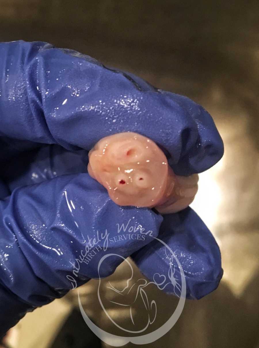 Hand in blue glove holding umbilical chords exposing it's vessels