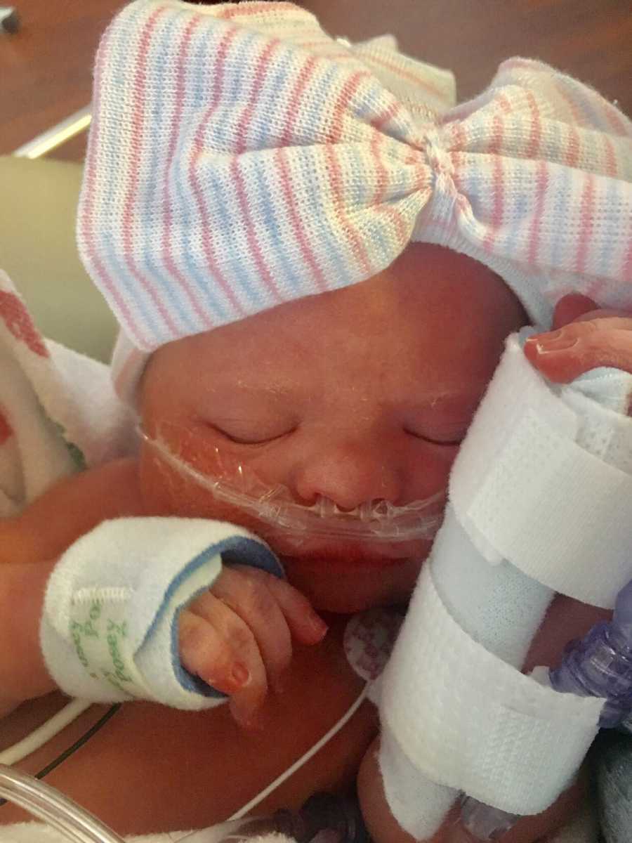 Newborn with down syndrome lays in NICU with oxygen up her nose and brace on her arm