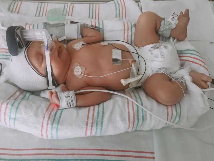 Twin with bradycardia lays asleep in NICU connected to monitors
