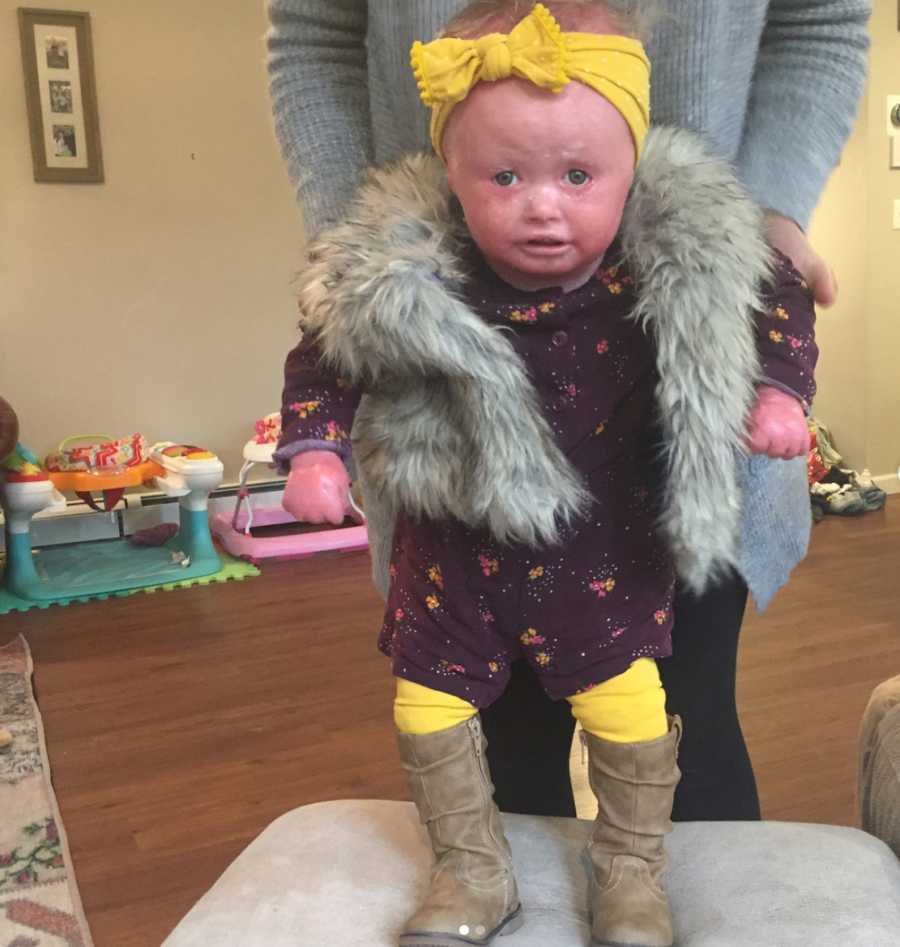 Baby with Harlequin Ichthyosis stands on ottoman wearing fur vest as mother holds her up