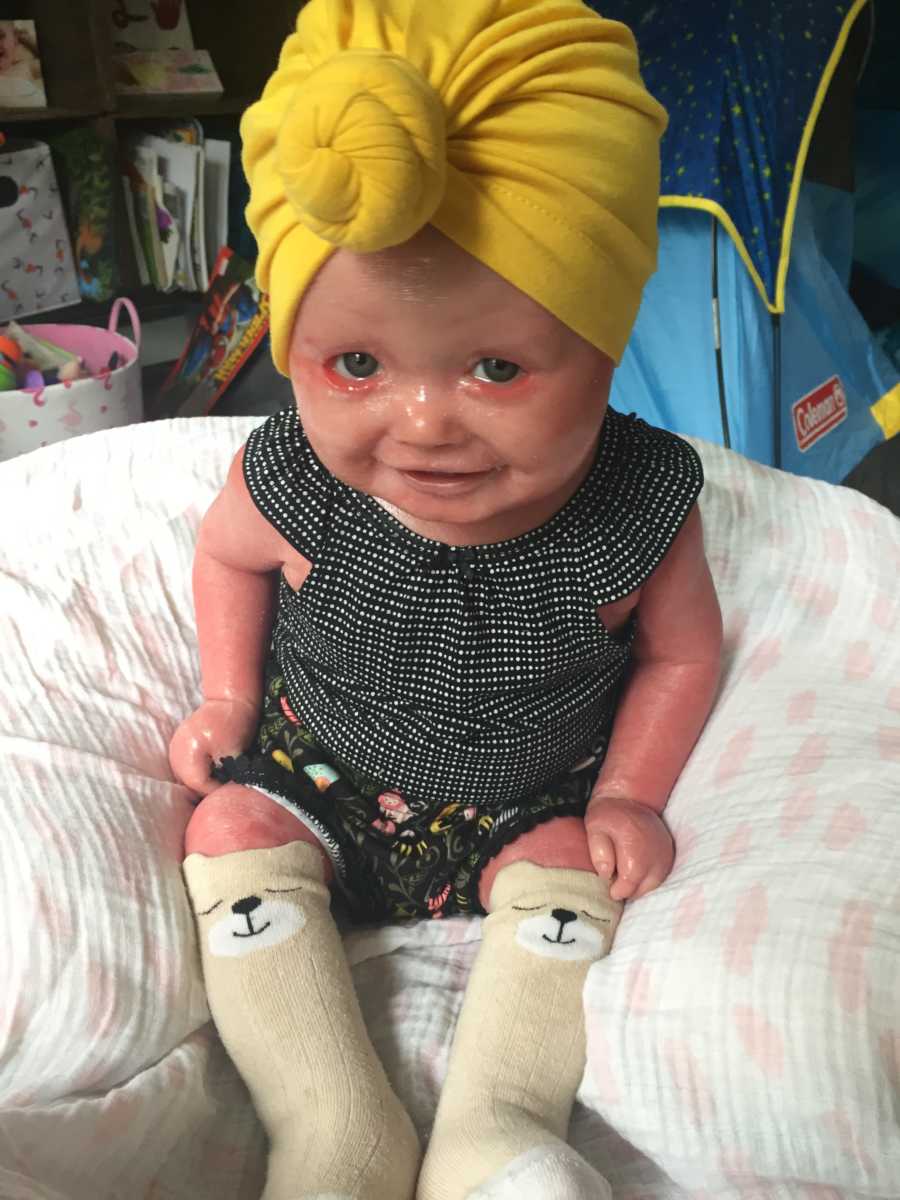 Baby with Harlequin Ichthyosis smiles while sitting on bean bag