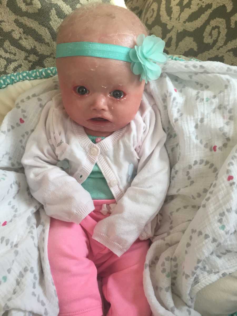 Baby with Harlequin Ichthyosis sits up wearing green headband with flower, white sweater and pink pants