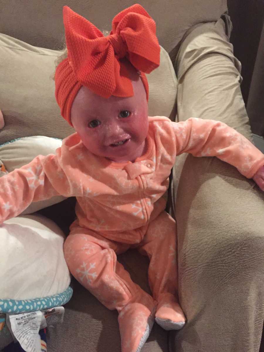 Baby with Harlequin Ichthyosis sits up in chair in orange onesie and big orange boy on her head