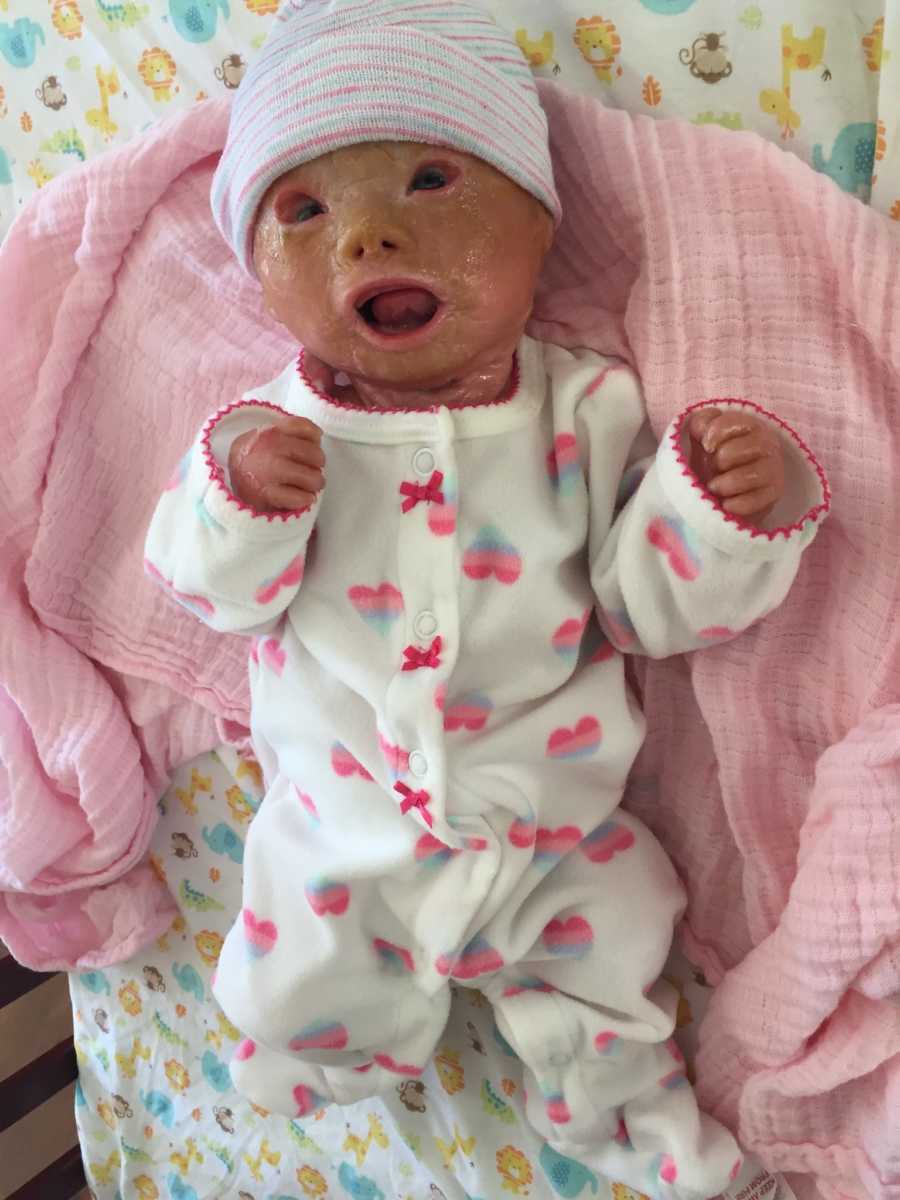 Newborn girl with Harlequin Ichthyosis lays on her back on pink blanket and white onesie with hearts on it