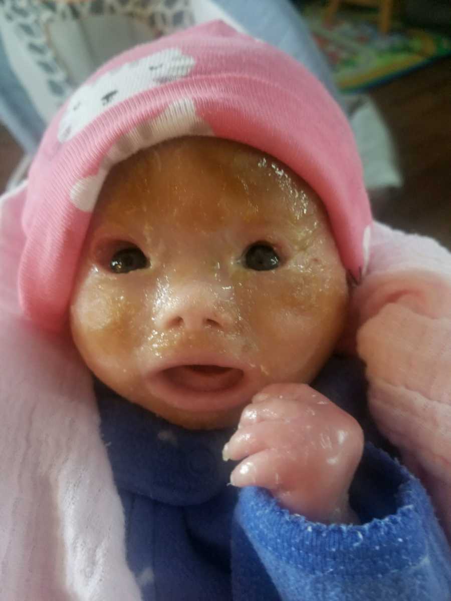 Close up of newborn's face with Harlequin Ichthyosis