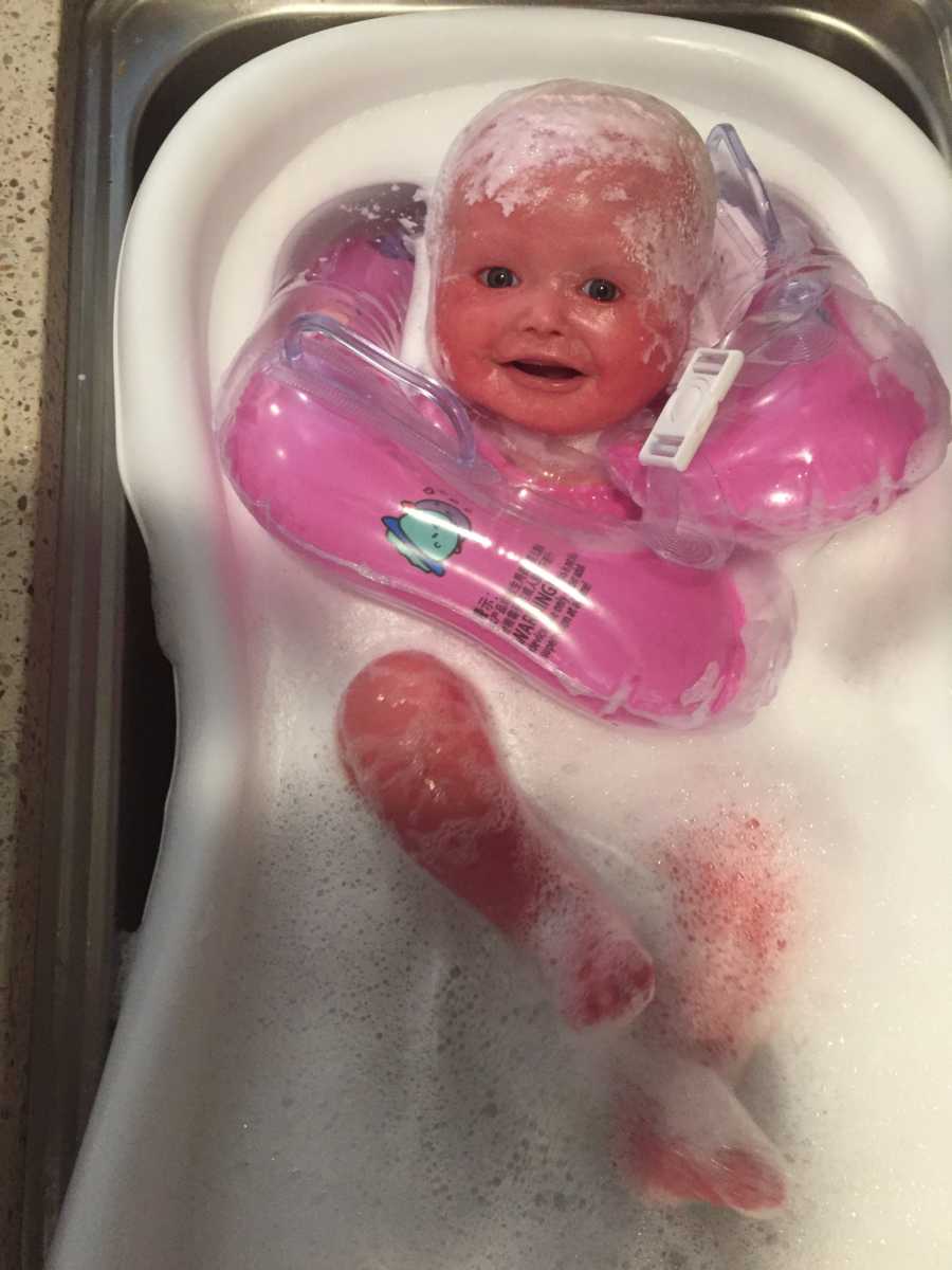 Baby with Harlequin Ichthyosis laying in baby bath smiling