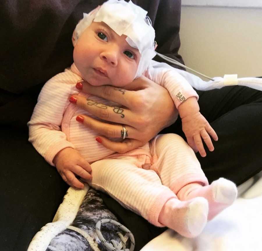 Baby with Lissencephaly and bandage on her head sits in pink and white stripe onesie on mothers lap 