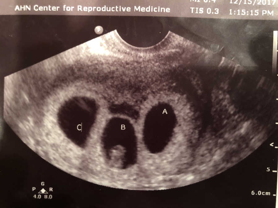 Ultrasound image of triplets