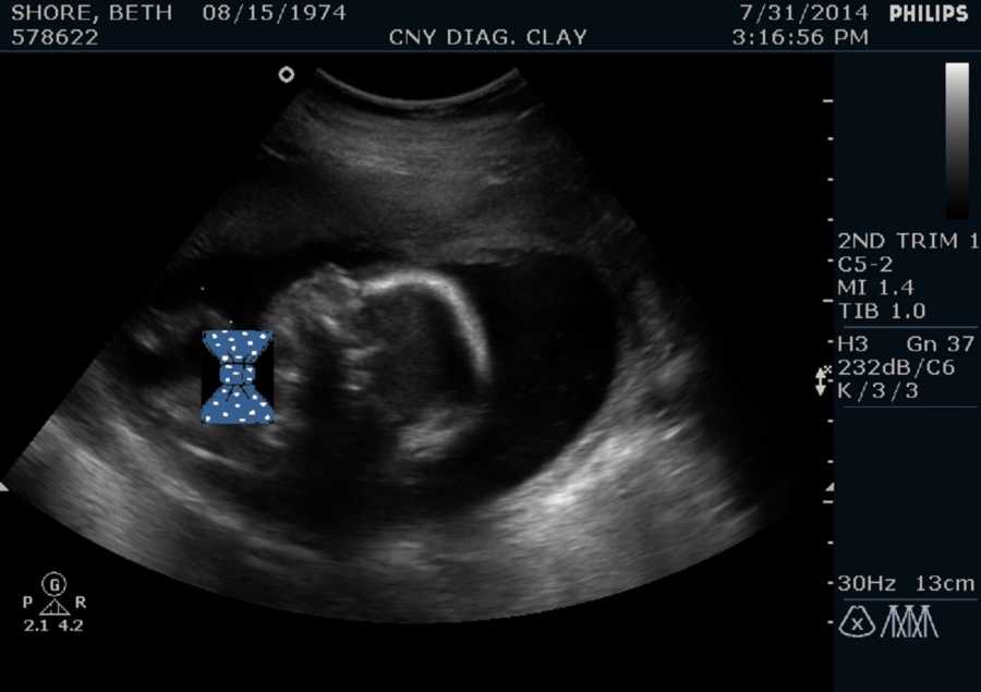 Ultrasound of baby with blue and white polka dot bow photoshopped over it