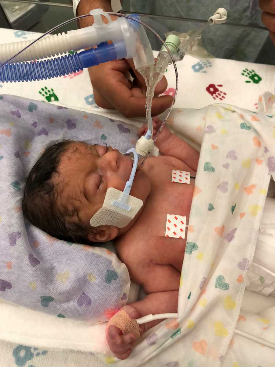 Newborn with Cornelia de Lange syndrome lays on back in NICU with pump attached to mouth