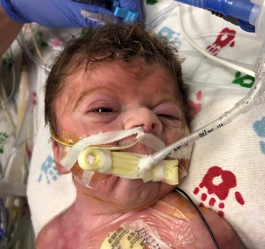 Close up of newborn with Cornelia de Lange syndrome with wires up his nose and in mouth