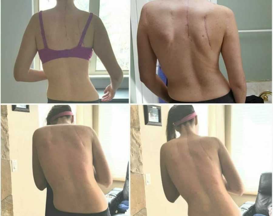 Back of teen with Ehlers-Danlos Syndrome who has scars from surgeries