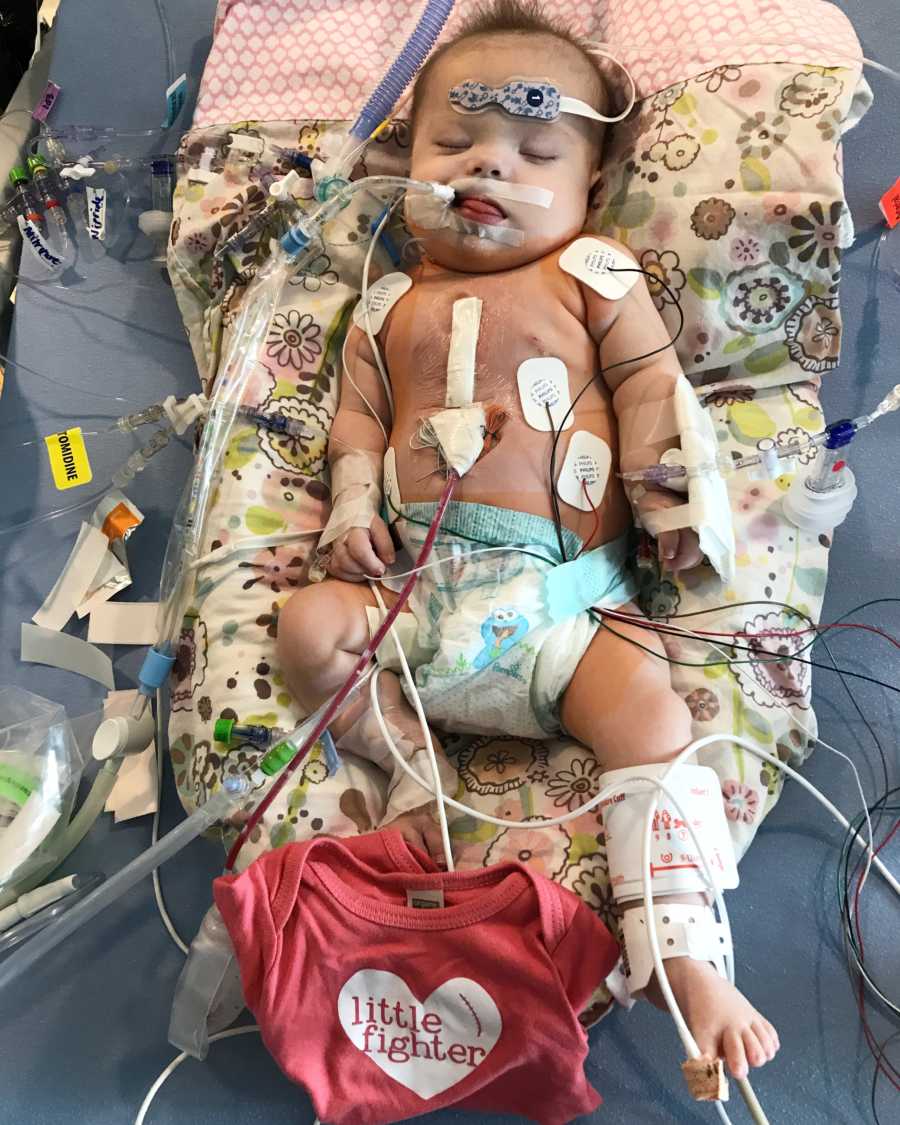 Baby with down syndrome and heart condition lays in PICU attached to monitors