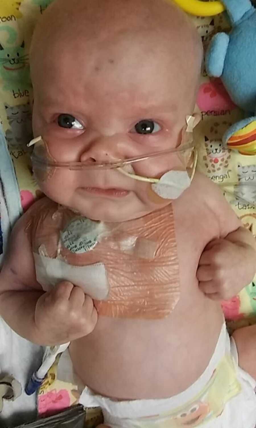 Newborn with brain cancer lays crying with tube up his nose
