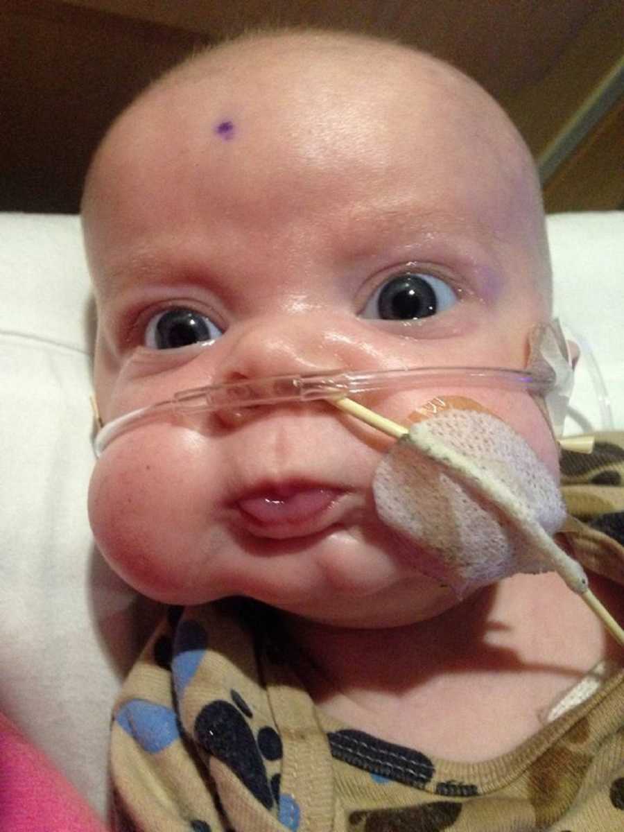 Close up of newborn who has brain cancers head that had purple dot on forehead and tube taped to his face