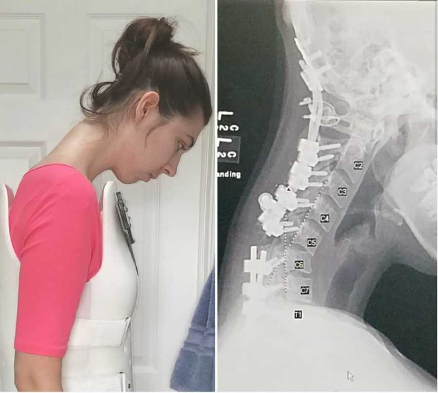 Side by side of teen with Ehlers-Danlos Syndrome standing with head bent over and her X-Ray
