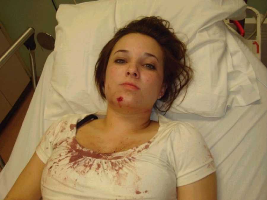 Woman lays in hospital bed with bloody chin and bloody white shirt