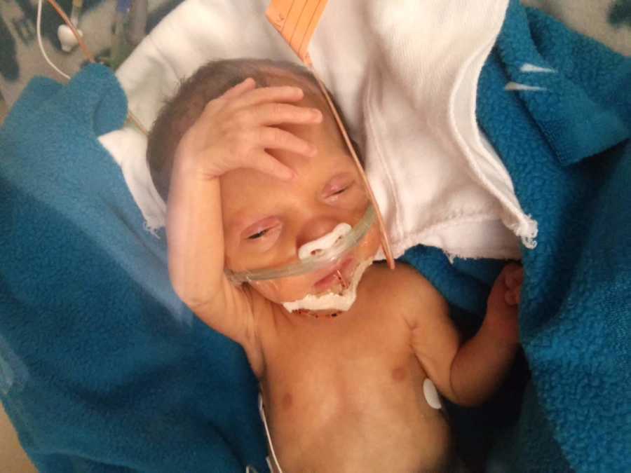 Newborn lays on back in NICU with tube up his nose