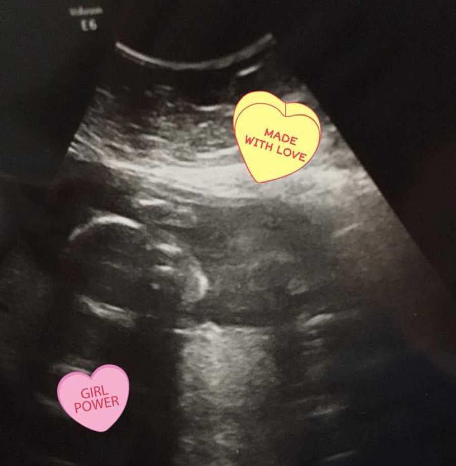 Ultrasound of baby girl with photoshopped candy hearts on it