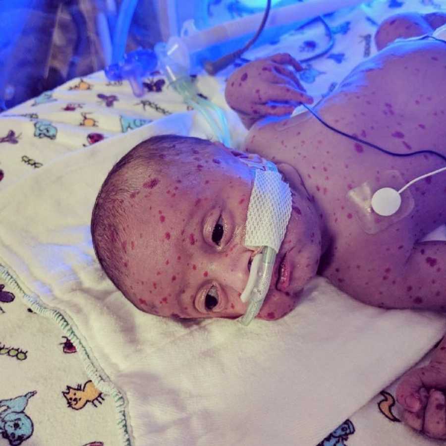 Newborn born with rare skin condition lay son back in NICU 