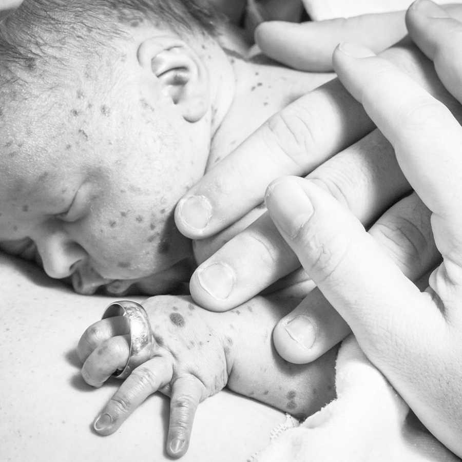 Newborn with rare skin condition lays on parent's chest holding onto their wedding ring