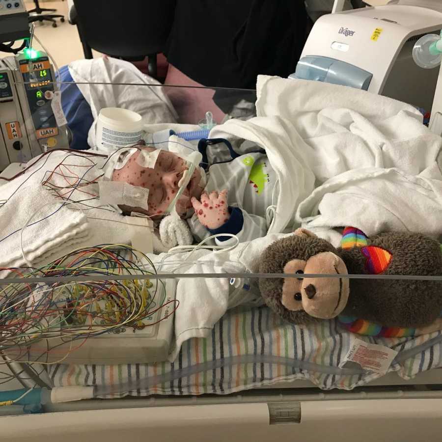 Newborn with rare skin condition lays asleep in NICU covered in blankets with stuffed monkey beside him
