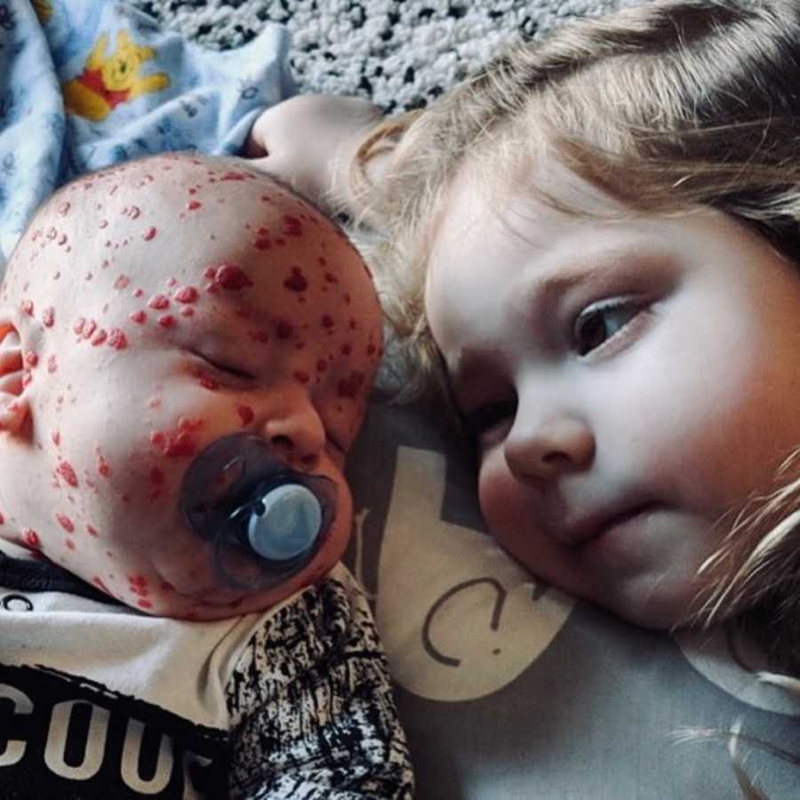 Baby with rare skin disease lays asleep while older sister lays beside him looking at him