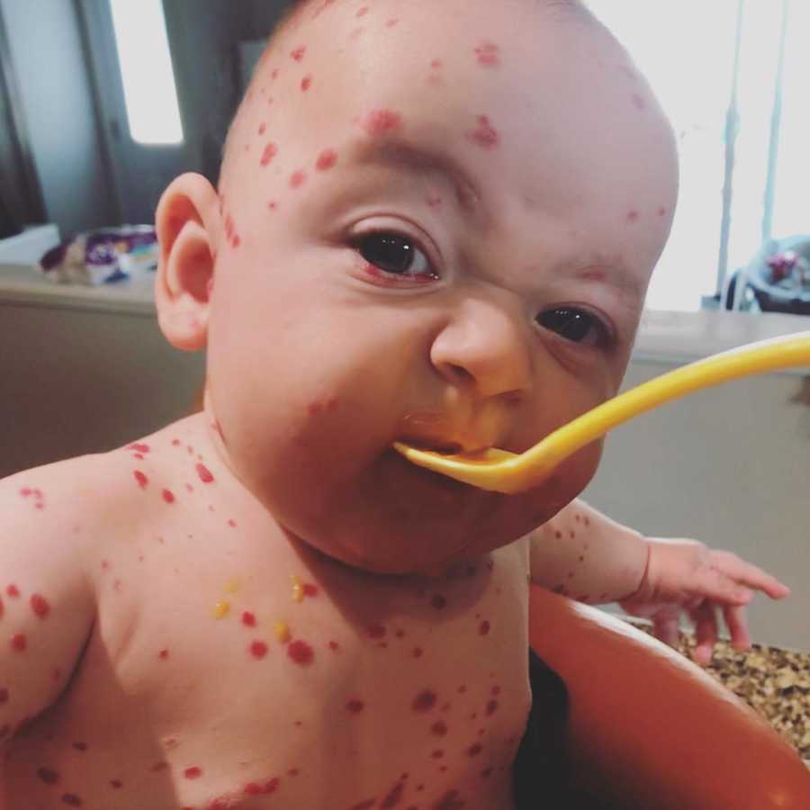 Baby with rare skin condition sits in high chair with yellow spoon in his mouth