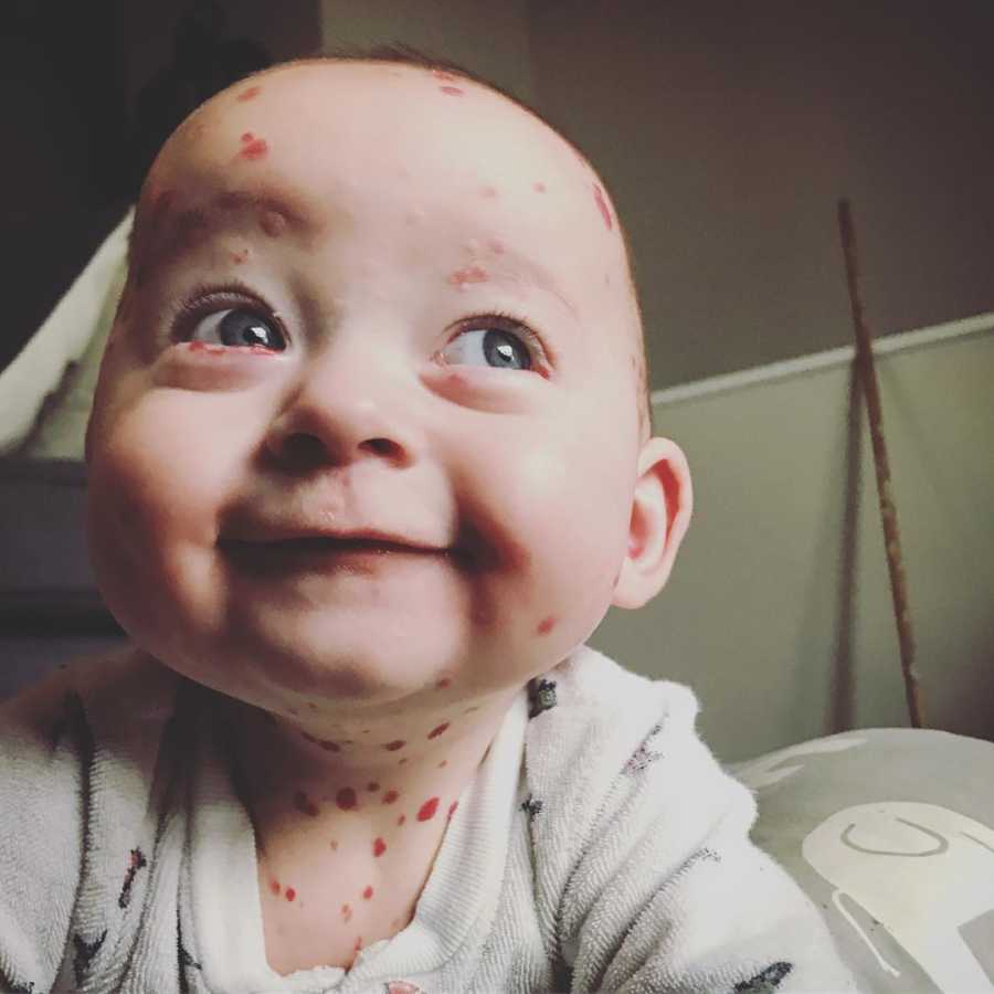 Baby with rare skin condition smiles at home