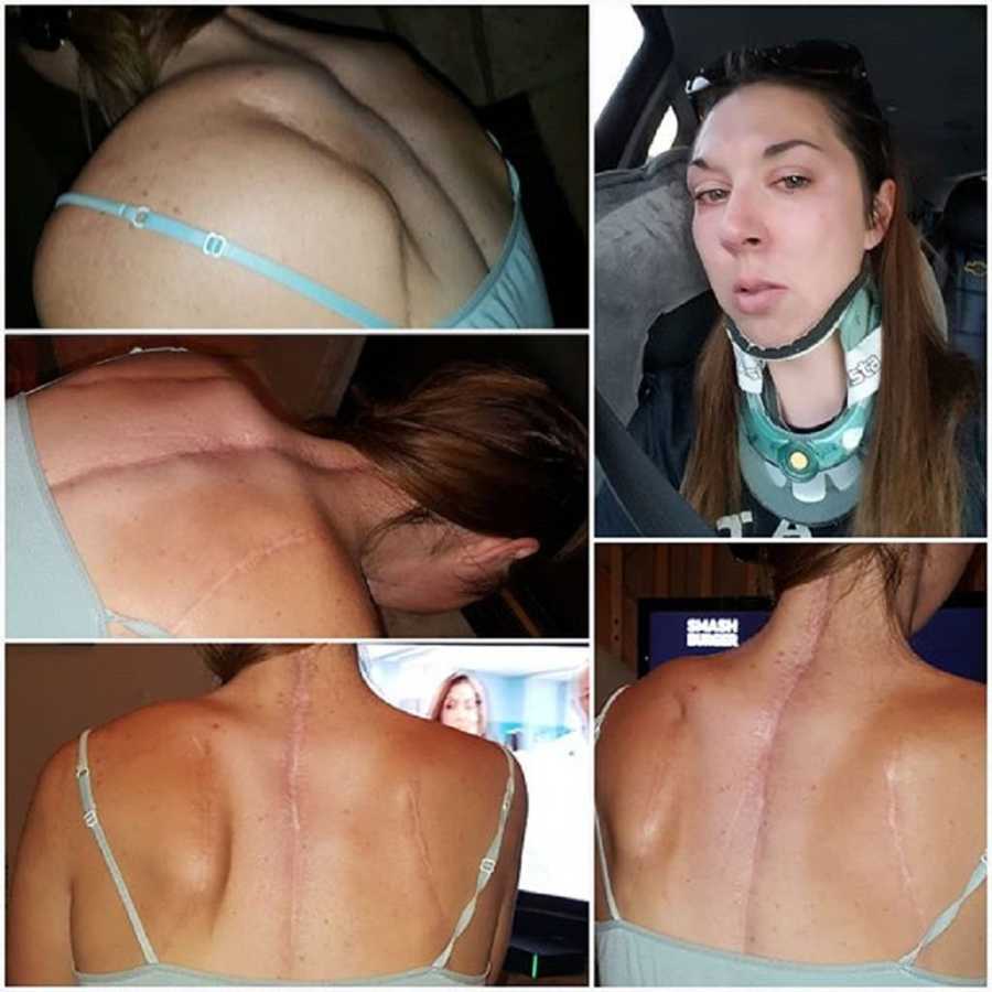 Collage of young woman's back covered in scars who has Ehlers-Danlos Syndrome