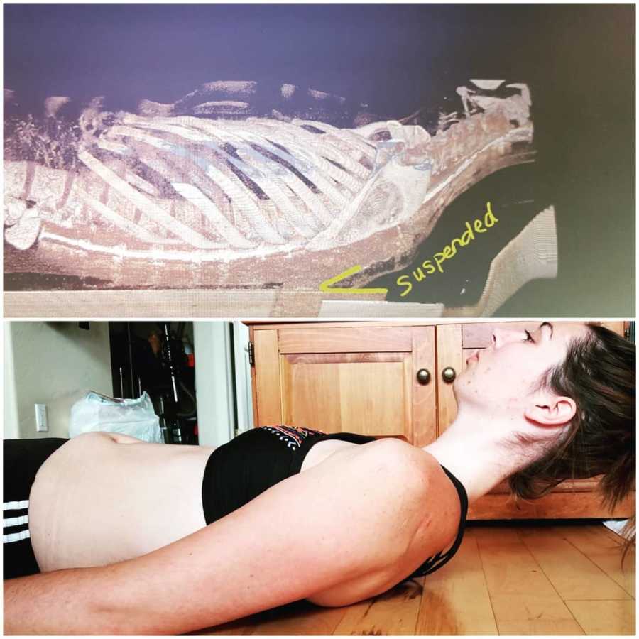 Side by side of young woman's ex-ray with Ehlers-Danlos Syndrome beside her lying on her back
