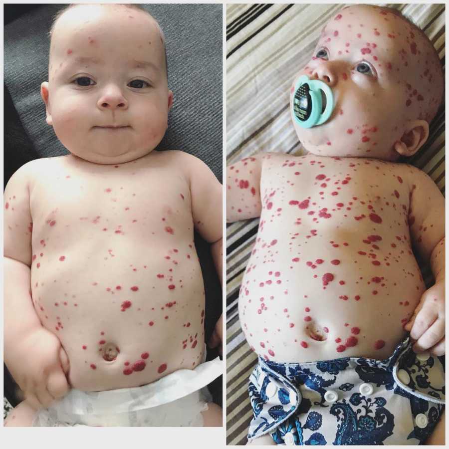 Side by side of baby with rare skin condition with red spots all over his skin
