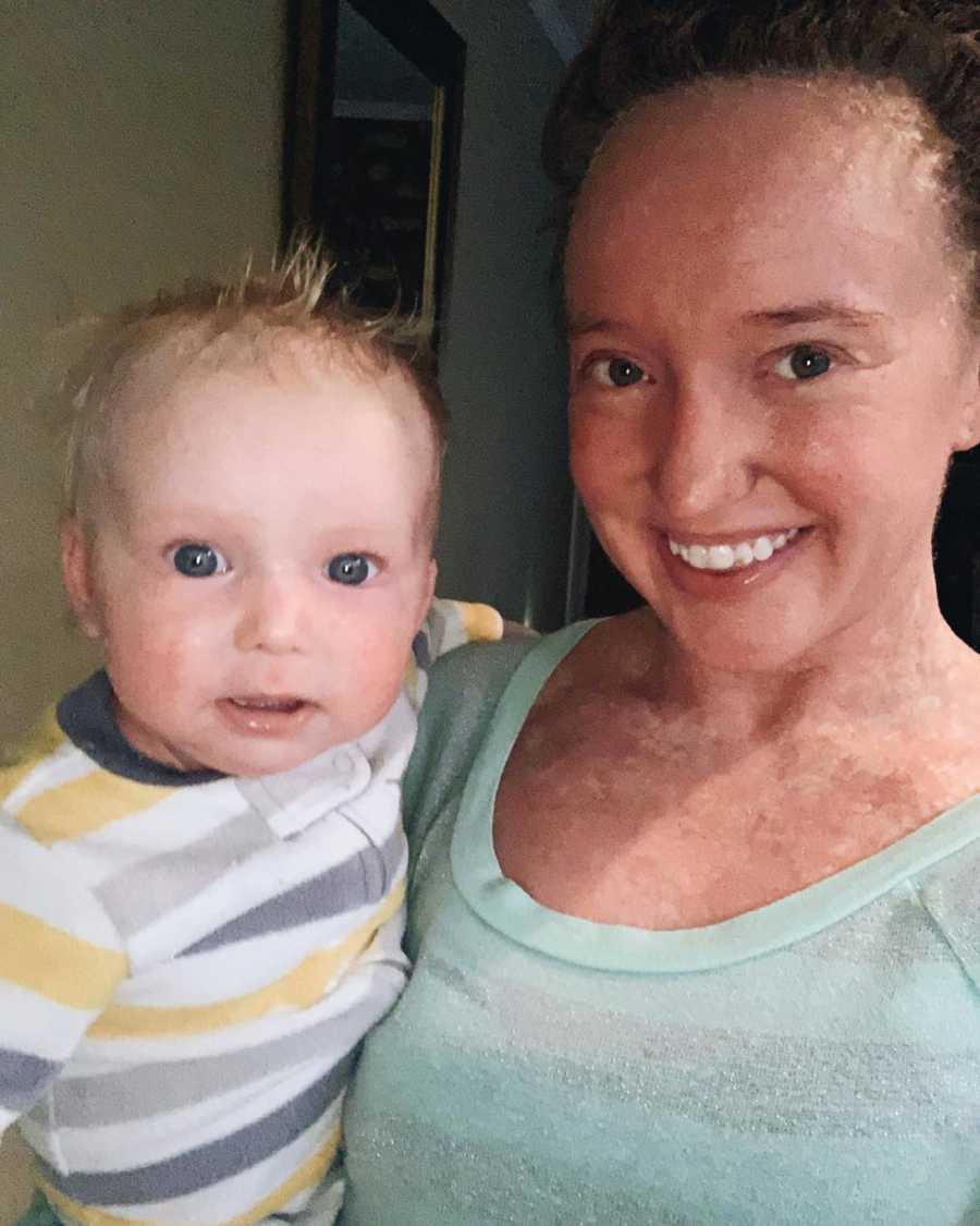Mother with Ichthyosis smiles as she holds baby son with Ichthyosis
