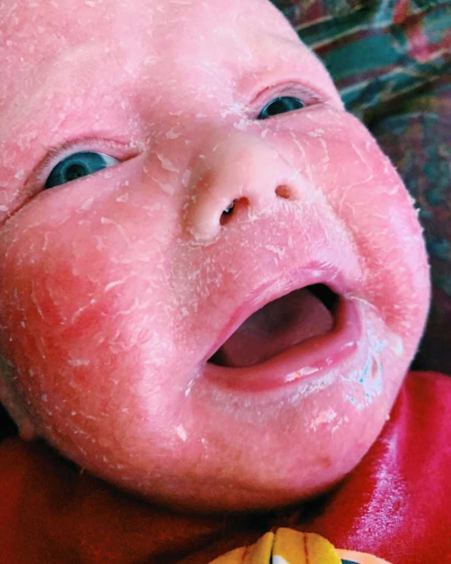 Close up of baby with Ichthyosis' face that is peeling