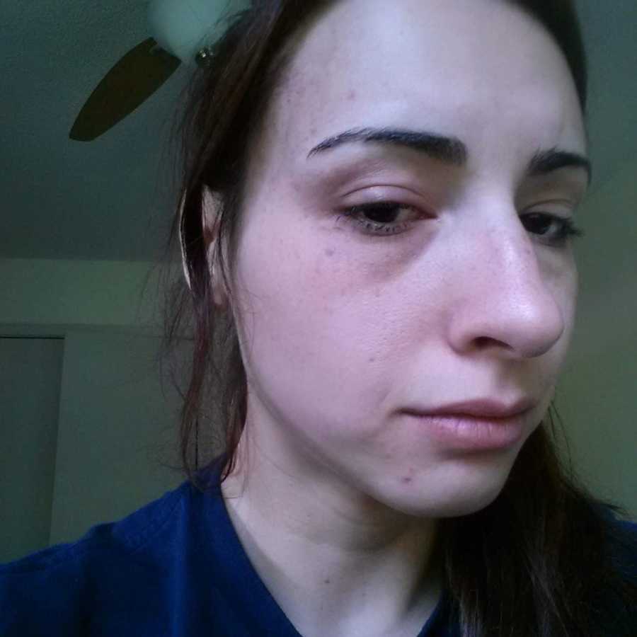 Selfie of woman with swollen face after boyfriend hit her